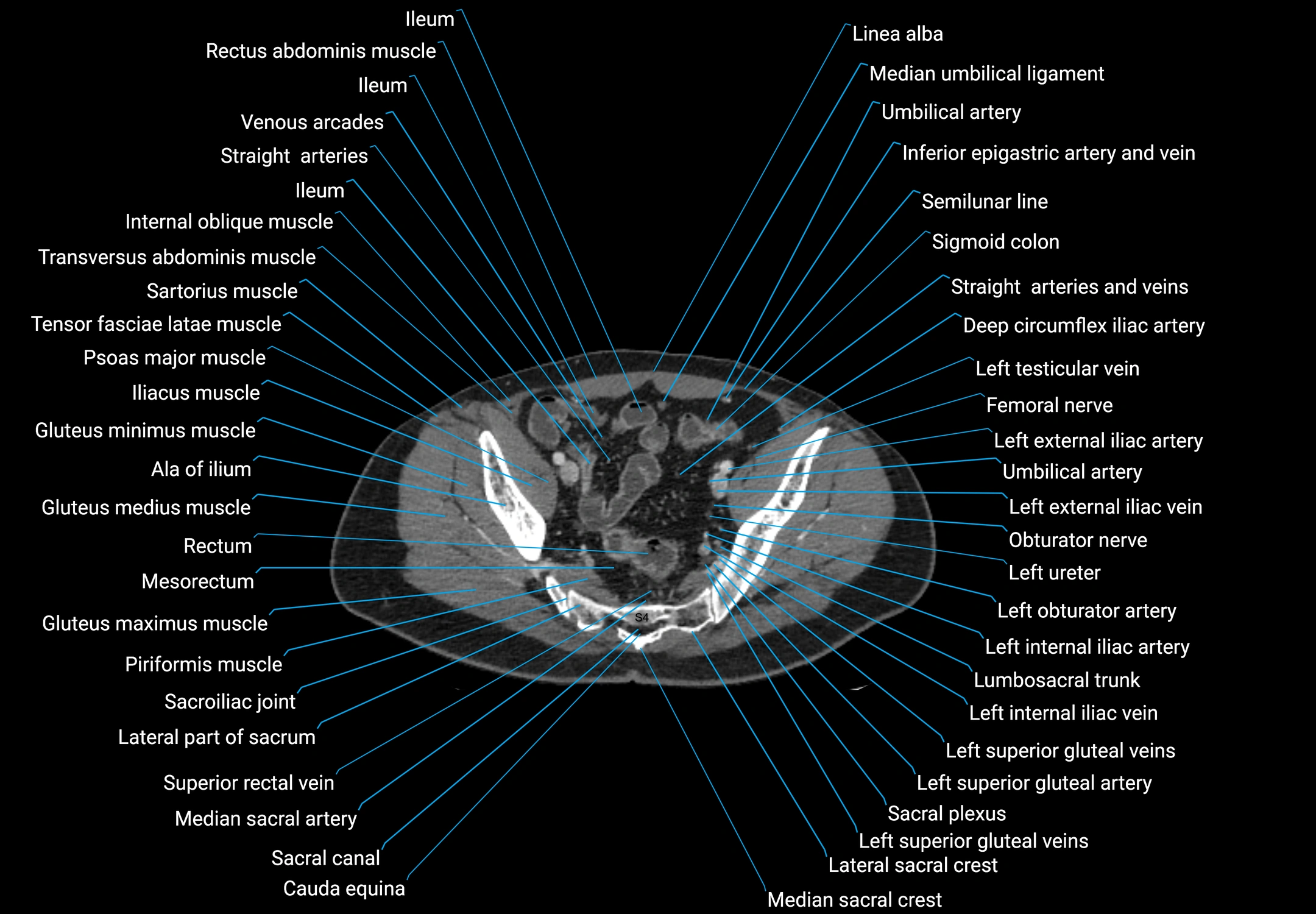 CT male pelvis axial cross sectional anatomy labelled radiology image -00163.webp